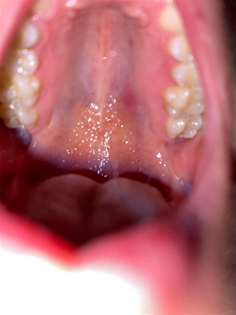 Red sore patch on roof of mouth : r/askdentists