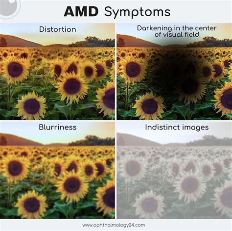 Image result for Macular Degeneration Vision Examples