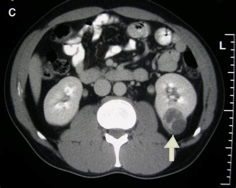 Image result for Robotic Partial Nephrectomy Video Animation