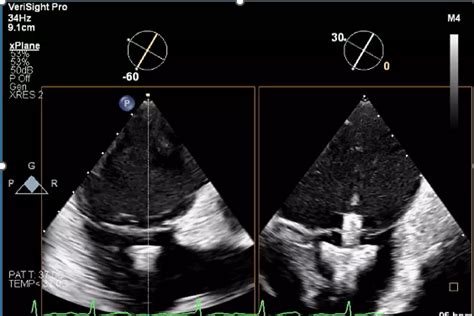 Intracardiac echocardiography (ICE) - Philips