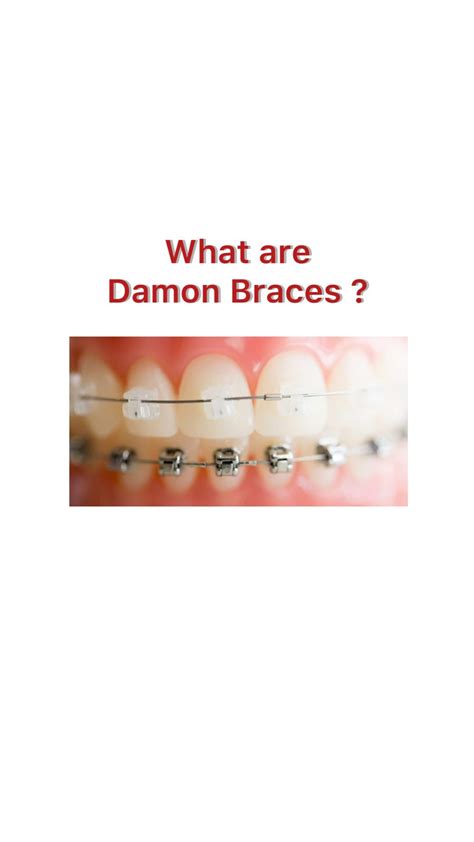 Damon Braces Vs Traditional Braces