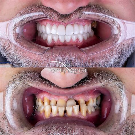 Dental Implants Full Mouth