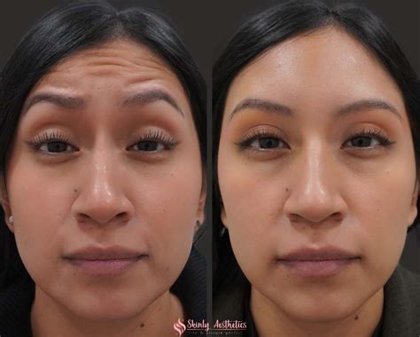 Botox Before and After Results - Everything You Need to See & Know
