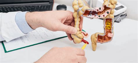 Image result for Appendicitis