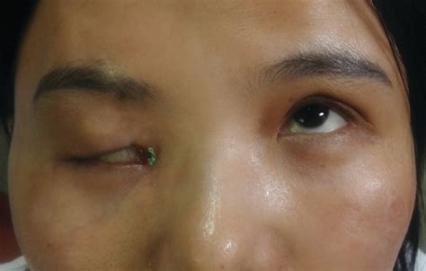 Eyelid Trauma Reconstruction Surgery in Gurugram | Dr. Svati Bansal