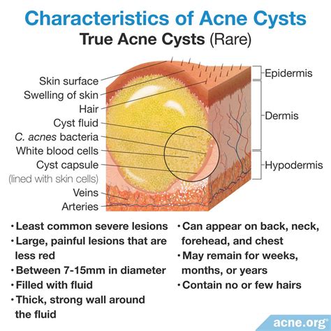 What Is an Acne Cyst? - Acne.org