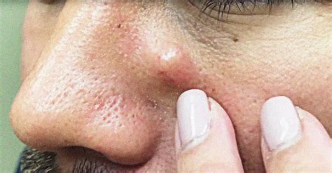 Image result for Exploding Pimple Popper