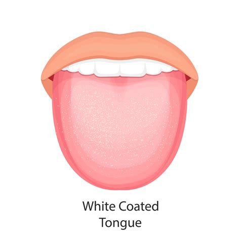 White Tongue Coating