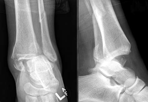 Ankle Fracture | Simcoe-Muskoka Orthopaedics