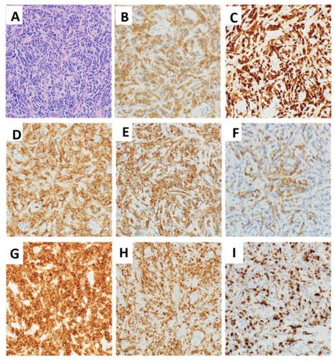 Hypodiploid B-Lymphoblastic Leukemia Presenting as an Isolated Orbital ...