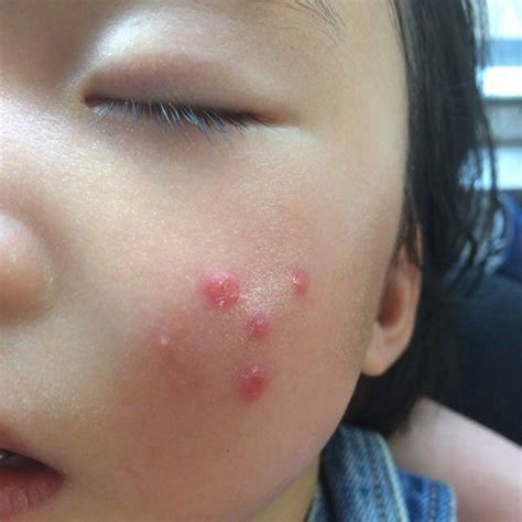 宝宝脸上长痘痘,儿童脸部疱疹初期图片 - 伤感说说吧