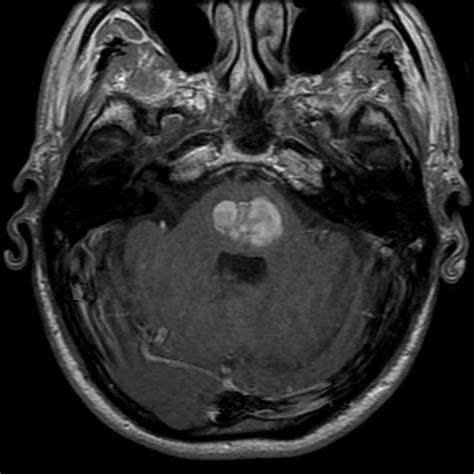Intracerebral Hemorrhage (ICH) - Neuropedia - Neuropathy - hemorrhage in pons