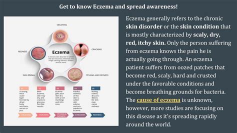 PPT - Get to know Eczema and spread awareness! PowerPoint Presentation ...