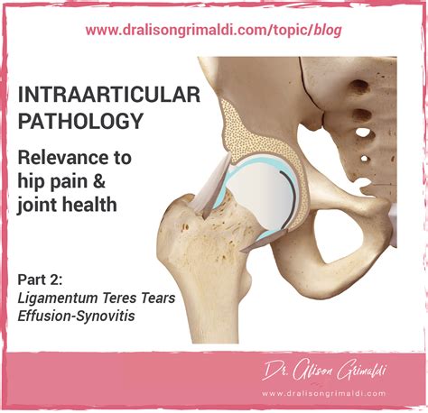 Intraarticular pathology - relevance to hip pain and joint health ...