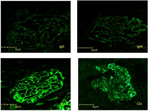 Acute IgA-Dominant Glomerulonephritis Associated with Syphilis ...