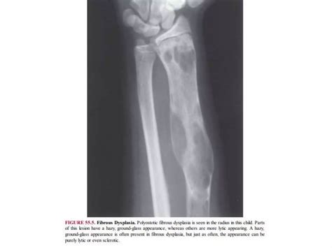 Lytic lesions of bone | PPTX