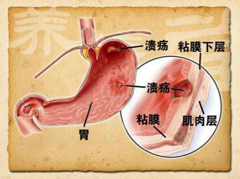 导致胃溃疡的病因都有哪些？_福州肛肠医院_福州医博肛肠医院