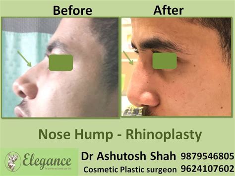 Nose Hump Rhinoplasty In Parbhani, Maharashtra, India