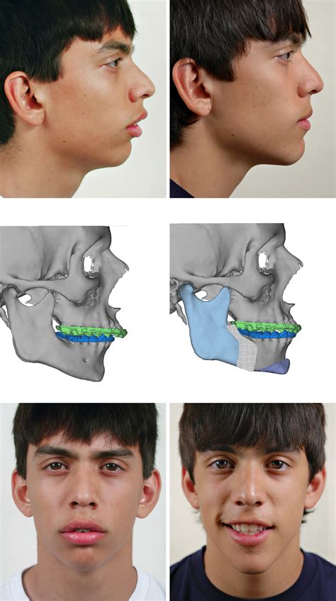 Orthognathic Surgery Before And After Overbite at Janice Harvell blog