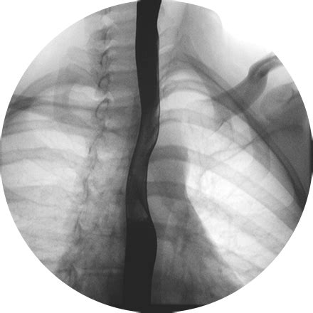 Image result for Fluoroscopy without Contrast