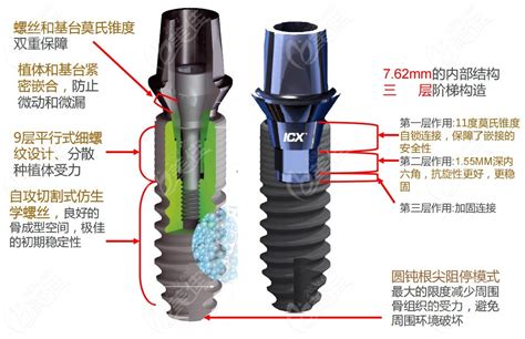 德国icx种植牙多少钱?种一颗德系ICX植体8K+|全口13W元起 - 口腔资讯 - 牙齿矫正网