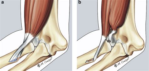 Distal biceps short head tears: repair, reconstruction, and systematic review - Journal of ...