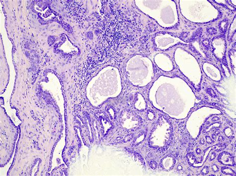 Tubular Apocrine Adenoma Icd 10