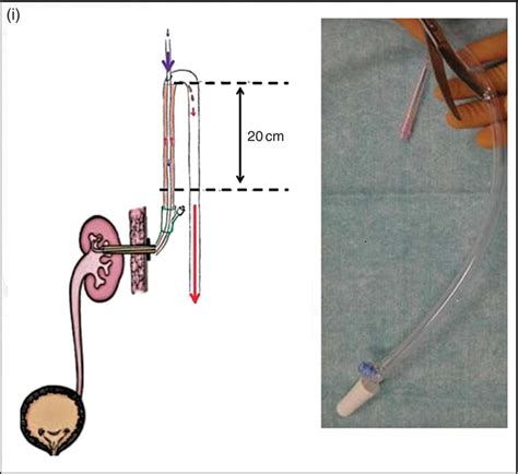 Percutaneous Instillation of Chemolytic, Chemotherapeutic, and Antifungal Agents | Abdominal Key