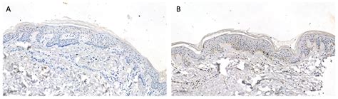 Gasdermin D (GSDMD) Is Upregulated in Psoriatic Skin—A New Potential ...