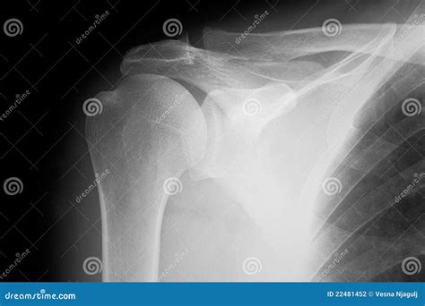 Plain Film X-ray of Shoulder - Radiography, Normal Stock Photo - Image ...