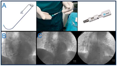 Lumenless and Stylet-Driven Leads for Left Bundle Branch Area Pacing ...