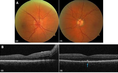 Syphilis detected with macular optical coherence tomography - Canadian Journal of Ophthalmology