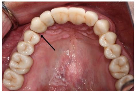Retrospective 1- to 8-Year Follow-Up Study of Complete Oral ...