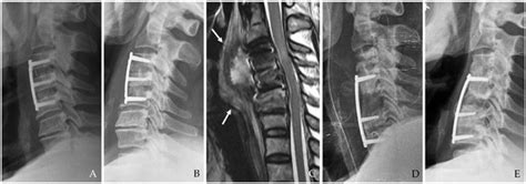 Postoperative Infection After Esophageal Injury in Anterior Cervical ...