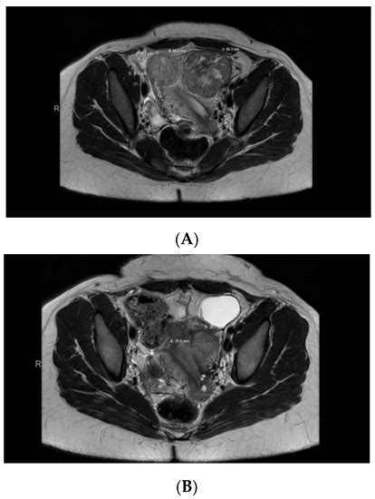 Investigating Fumarate Hydratase-Deficient Uterine Fibroids: A Case Series