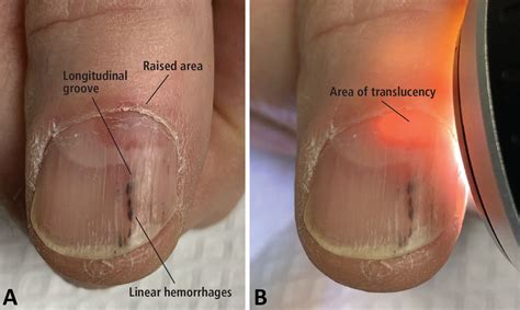 Raised Bumps On Fingernails