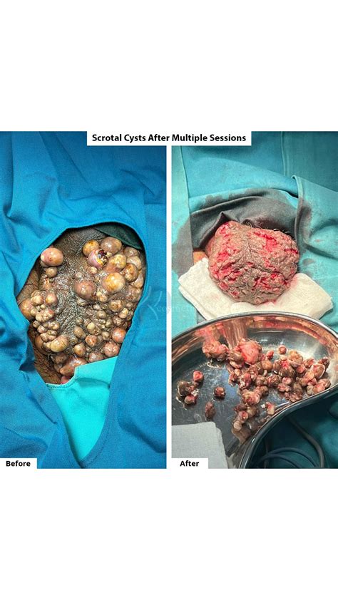 Scrotal Cyst Treatment