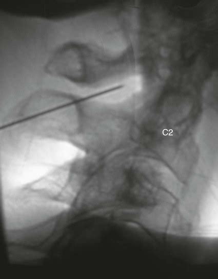 Image result for Selective Root Nerve Block Fluoroscopy