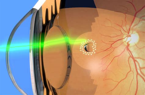Comparing Laser Eye Surgery Prices