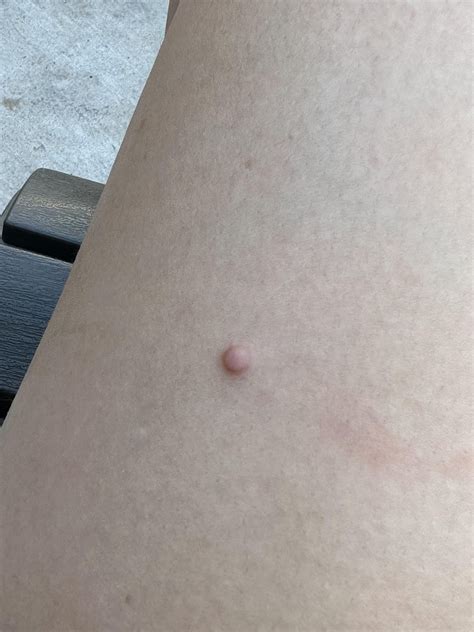 What is this small red bump on my thigh? : r/DermatologyQuestions