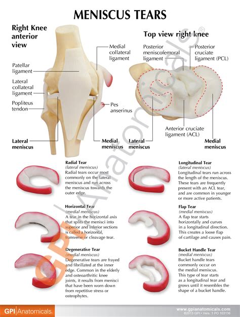 Knee Model with Meniscus Tears – GPI 3D Anatomy