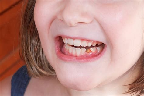 Tooth Socket After Extraction 的图像结果