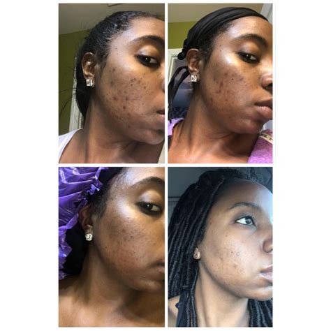 Testimonials and Success Stories: Real People, Real Results with Kojic – Koji White