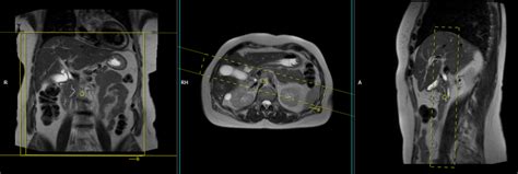 Image result for Abnormal MRCP