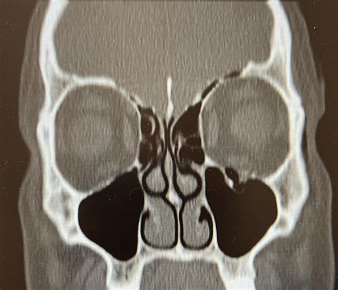 Orbital Floor Fracture Xray