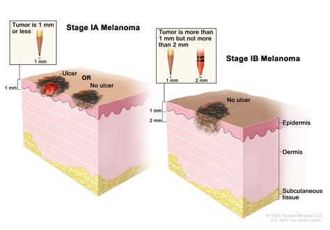 Melanoma Skin Cancer Stages