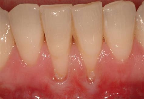 Help with Receding Gums - ToothStars