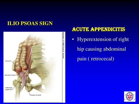 Image result for Psoas Sign
