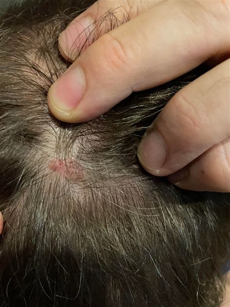 melanoma on the scalp: skin cancer on scalp – MWTV