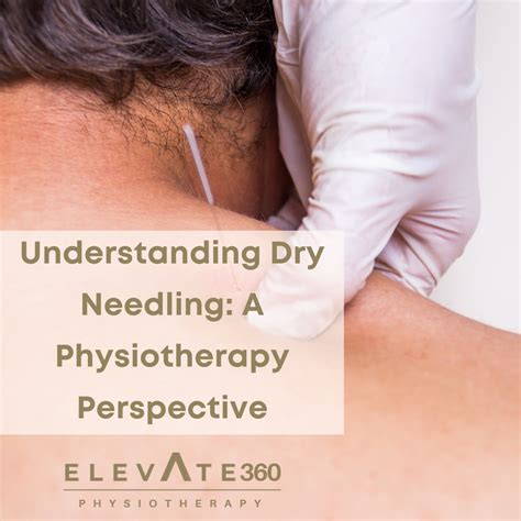 Understanding Dry Needling: A Physiotherapy Perspective - Elevate Physiotherapy
